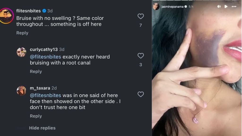 90 DAY FIANCE JASMINE FAKE BRUISE